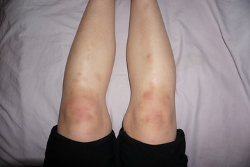Many mark of bruise contusion on knee and leg, hematoma of tissue localized internal bleeding...