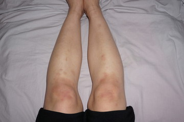 Many mark of bruise contusion on knee and leg, hematoma of tissue localized internal bleeding...