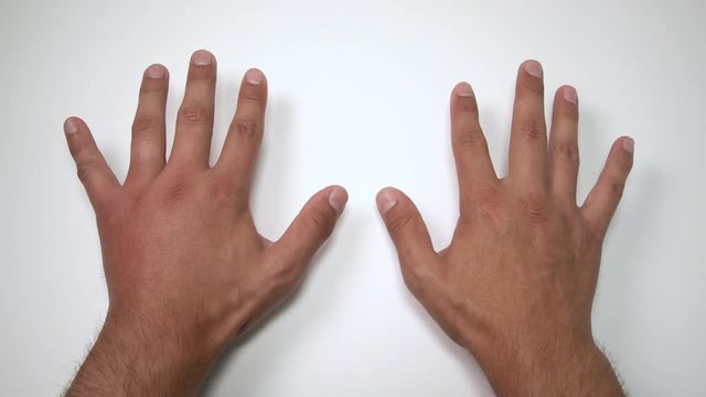 Comparison of two male hands stung by bee or wasp. Hand swelling, inflammation, redness are signs of infection. Insect bite on left hand on white background