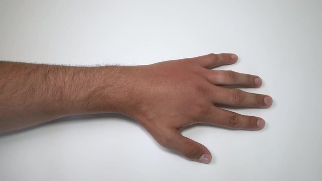 Male hand stung by bee or wasp. Hand swelling, inflammation, redness are signs of infection. Insect bite on left hand