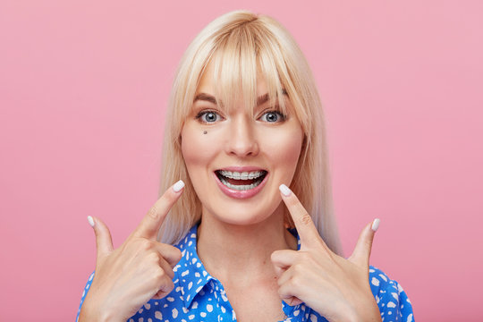 Cheerful happy young woman with blonde hair gesturing thumb up while pointing finger at braces on her teeth isolated over pink background. The concept of a healthy snow-white smile. Daily dental care