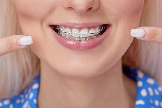Beautiful macro shot of white teeth with braces. Dental care photo. Beauty woman smile with ortodontic accessories. Orthodontics treatment. Closeup of healthy female mouth