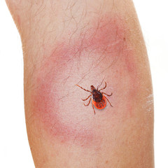 An Erythema Migrans rash often seen in the early stage of Lyme disease. It can appear after a tick...