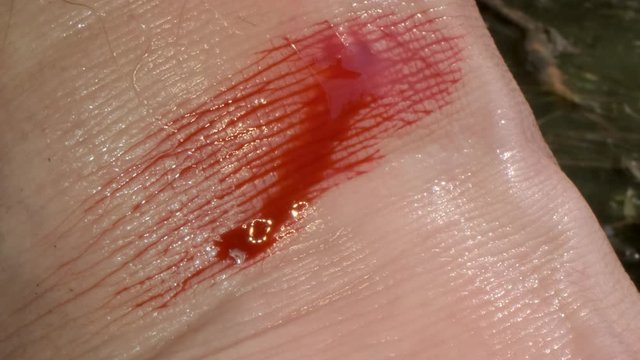 Wound and bleeding at leech bite. Close-up 