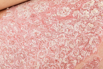 Man with sick hands, dry flaky skin on his hand with vulgar psoriasis, eczema and other skin...