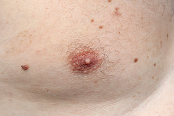 male nipple close-up. Large moles on the breast of a man in the nipple