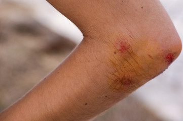 Fototapeta premium Cotovelo magoado