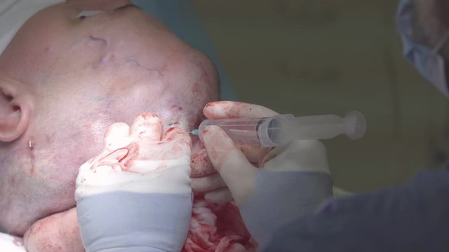 Surgeon makes an injeciton of a saline into the expander head ander the   head tissues during the plastic surgery (closeup, 4K, 25fps)