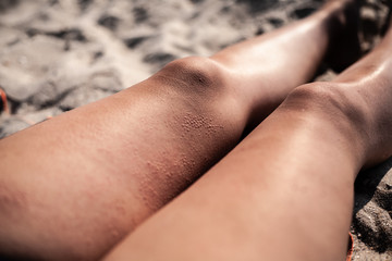 Blisters on the skin. On his feet in sunny weather, blisters on his hip.