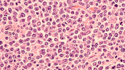 Lymphoma awareness: photomicrograph of a diffuse large B-cell lymphoma (DLBCL) a type of...