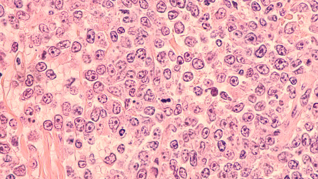 Lymphoma awareness: photomicrograph of a diffuse large B-cell lymphoma (DLBCL) a type of non-Hodgkin lymphoma.  This case is from the testis of an elderly man and shows prominent nucleoli. 