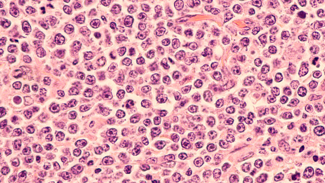 Lymphoma awareness: photomicrograph of a diffuse large B-cell lymphoma (DLBCL) a type of non-Hodgkin lymphoma.  This case is from the testis of an elderly man and shows prominent nucleoli. 