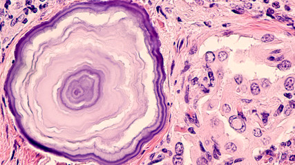Thyroid cancer: Psammoma bodies are granules of concentric layers of calcium commonly seen in...