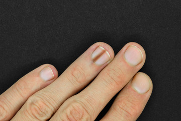 Finger with melanonychia