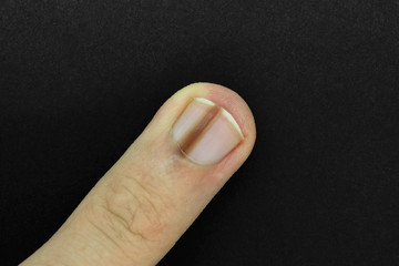 Finger nail with melanonychia