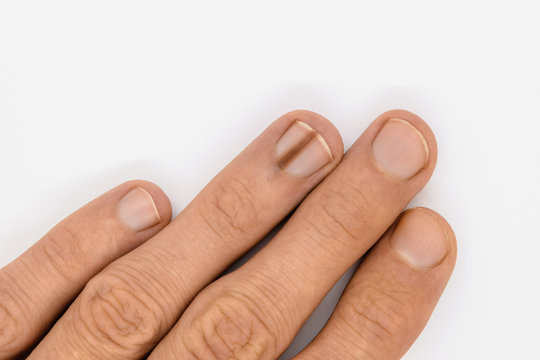 Finger nail with melanonychia