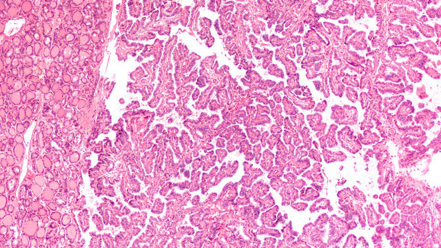Thyroid gland cancer awareness: Microscopic image of papillary thyroid carcinoma, characterized by branching papillae with fibrovascular cores. Normal thyroid is seen on the left.