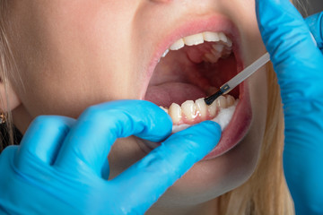 Dentistry. The patient is a teenage girl with an open mouth. The doctor smears teeth with...
