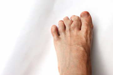 rheumatoid arthritis or gout affects the toes of young caucasian man. Recurrent attack of...