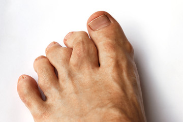 close-up of deformation of the toes caused by Rheumatoid polyarthritis with swelling of the foot of a young man. valgus deformity of the toes with pathologic enchondromas - obrazy, fototapety, plakaty