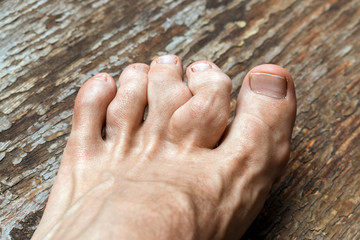 gouty toes. toes affected by Gout - a disease in which defective metabolism of uric acid....