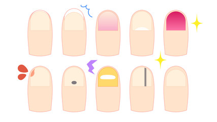 いろいろな状態の爪