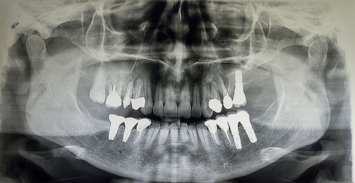 Orthopantomography of an adult patient