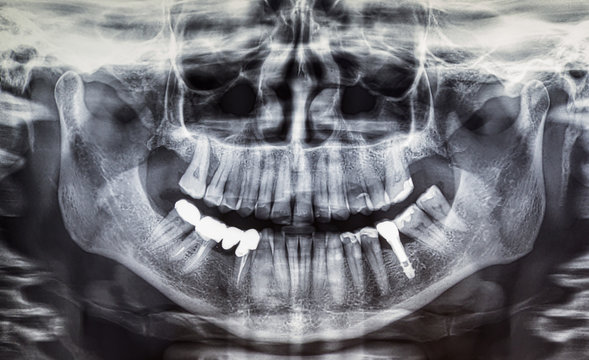 Orthopantomography of an adult patient