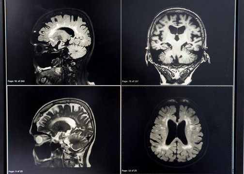 brain MRI for education Dementia Mix type stroke VaD