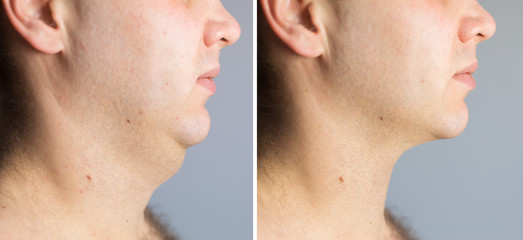 Man before and after double chin fat correction procedure - obrazy, fototapety, plakaty