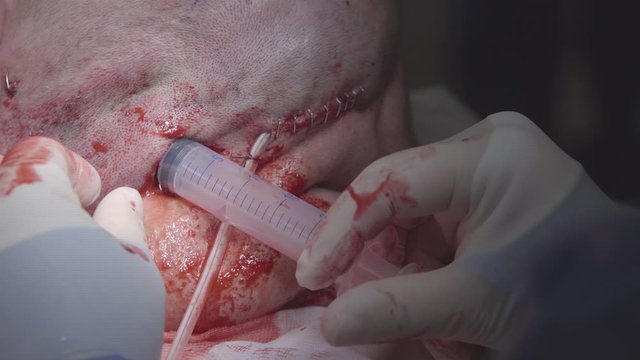 Surgeon makes an injection with a syringe into a head tissues during the surgery   (closeup, 4K, 25fps)