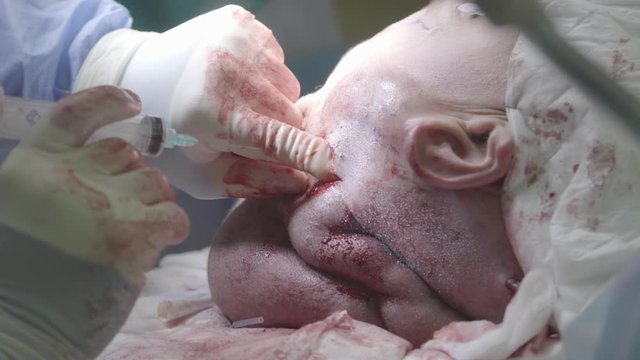 Injection into the expander inside a head skin during the surgery (closeup, 4K, 25fps)