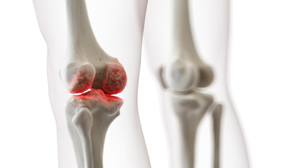 3d rendered medically accurate illustration of an arthritic knee joint - obrazy, fototapety, plakaty
