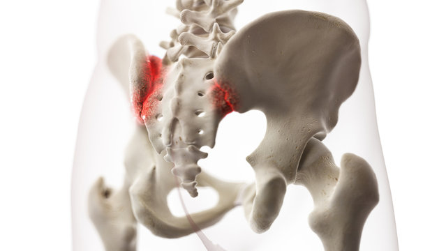 3d rendered medically accurate illustration of an arthritic iliosacral joint