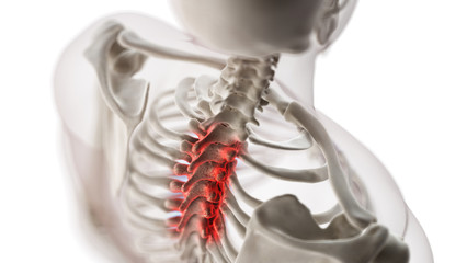 3d rendered medically accurate illustration of an arthritic thoracic spine - obrazy, fototapety, plakaty