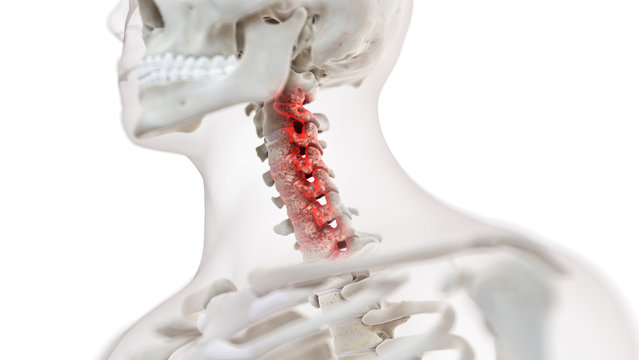 3d rendered medically accurate illustration of an arthritic cervical spine