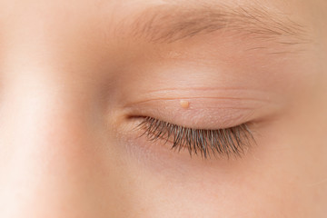 Close up of wart on eyelid. Young girl with papillomas on skin around eye, macro - obrazy, fototapety, plakaty
