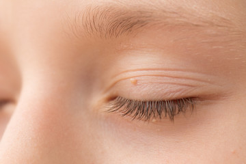 Fototapeta premium Close up of wart on eyelid. Young girl with papillomas on skin around eye, macro