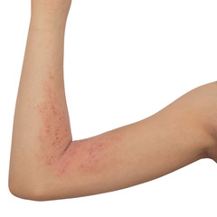 allergy skin