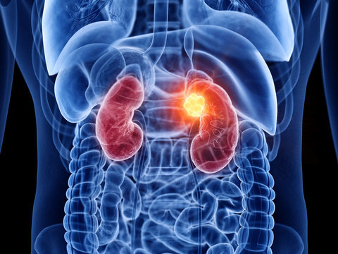 3d rendered medically accurate illustration of kidney cancer
