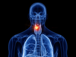 3d rendered medically accurate illustration of larynx cancer