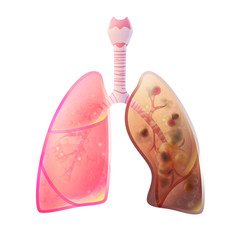 Vector illustration of lung cancer
