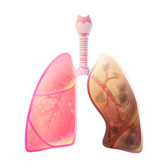 Vector illustration of lung cancer