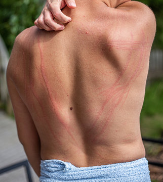Dermatographic urticaria (also known as dermographism, dermatographism or "skin writing") is a skin disorder and one of the most common types of urticaria. Photo of skin writing on a back of a man.  S