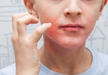 Boy scratching his face. Human skin, presenting an allergic reaction, allergic rash on face and...