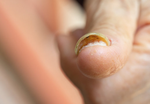 Nail With Advanced Fungal Disease