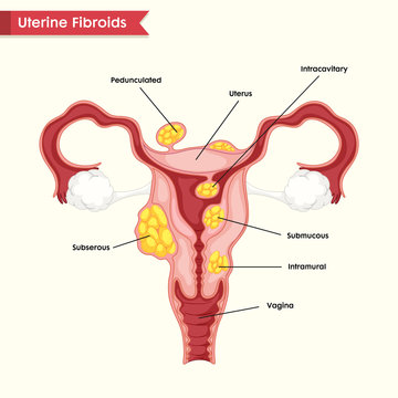Scientific medical illustration of diseased vagina