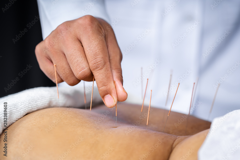 Canvas Prints close-up of senior female back with steel needles during procedure of acupuncture therapy