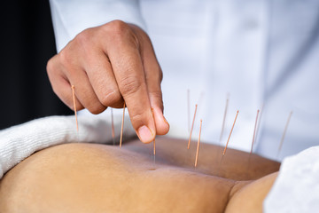 Close-up of senior female back with steel needles during procedure of acupuncture therapy