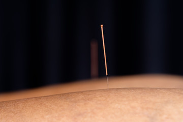 therapy of leg with pricking acupuncture needles